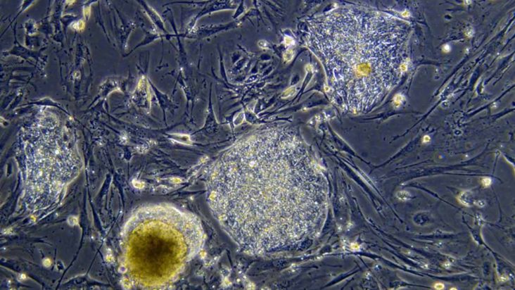 Kmeňové bunky z placenty na liečbu rakoviny